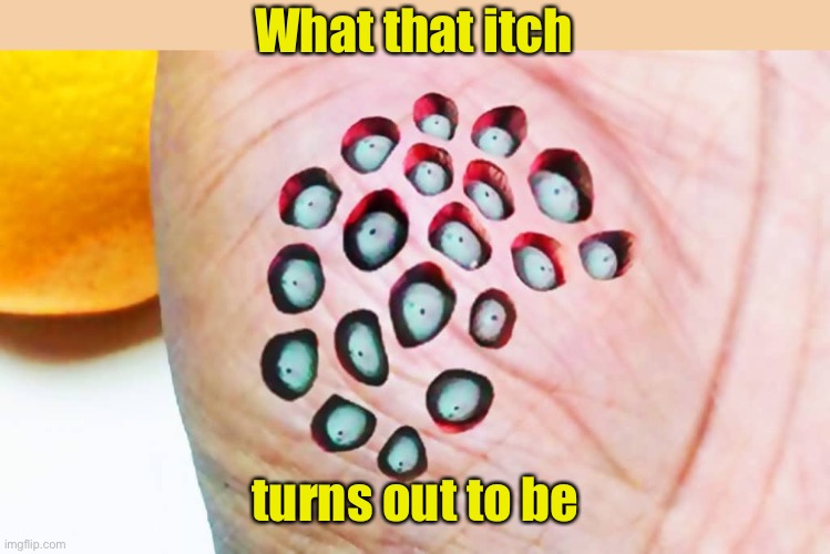Hope you don’t suffer from Trypophobia | What that itch; turns out to be | image tagged in parasite,creepy,phobia | made w/ Imgflip meme maker