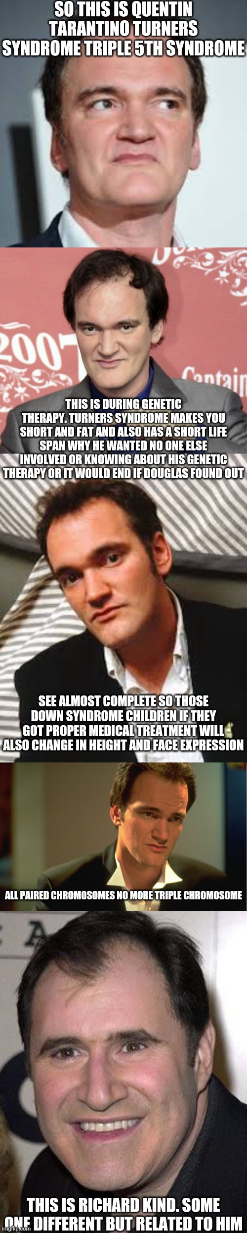 I DONT CARE HE WILL ACTUALLY GET MORE FEMALE ADMIRERS LOOKING FOR A GENE TEST AT WHAT CANCELS TURNERS SYNDROME | SO THIS IS QUENTIN TARANTINO TURNERS SYNDROME TRIPLE 5TH SYNDROME; THIS IS DURING GENETIC THERAPY. TURNERS SYNDROME MAKES YOU SHORT AND FAT AND ALSO HAS A SHORT LIFE SPAN WHY HE WANTED NO ONE ELSE INVOLVED OR KNOWING ABOUT HIS GENETIC THERAPY OR IT WOULD END IF DOUGLAS FOUND OUT; SEE ALMOST COMPLETE SO THOSE DOWN SYNDROME CHILDREN IF THEY GOT PROPER MEDICAL TREATMENT WILL ALSO CHANGE IN HEIGHT AND FACE EXPRESSION; ALL PAIRED CHROMOSOMES NO MORE TRIPLE CHROMOSOME; THIS IS RICHARD KIND. SOME ONE DIFFERENT BUT RELATED TO HIM | image tagged in quentin tarantino | made w/ Imgflip meme maker