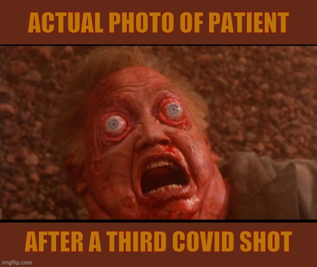 The Covid shot. It will mutate the masses. | ACTUAL PHOTO OF PATIENT; AFTER A THIRD COVID SHOT | image tagged in total recall mars face,covid-19 vaccine,thuh vaxx,vaxx,vaxx mutos,covid-19 vaccine sterile mutations | made w/ Imgflip meme maker