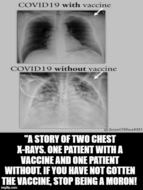 Stop being a MORON!!! Get the vaccine!! | "A STORY OF TWO CHEST X-RAYS. ONE PATIENT WITH A VACCINE AND ONE PATIENT WITHOUT. IF YOU HAVE NOT GOTTEN THE VACCINE, STOP BEING A MORON! | image tagged in stupid,morons,antivax,idiots,covidiots,stupidity | made w/ Imgflip meme maker
