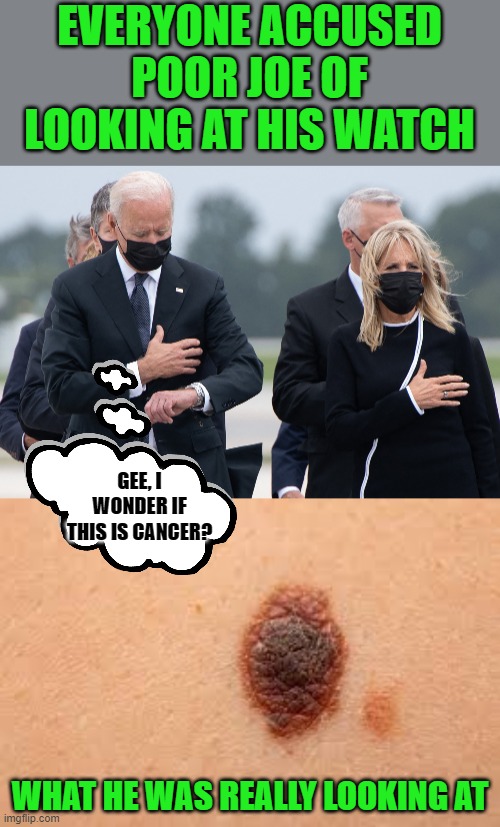 He did go to Walter Reed later in the week to "visit the troops" | EVERYONE ACCUSED POOR JOE OF LOOKING AT HIS WATCH; GEE, I WONDER IF THIS IS CANCER? WHAT HE WAS REALLY LOOKING AT | image tagged in biden watch,skin cancer | made w/ Imgflip meme maker