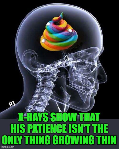 Brain X-Ray | X-RAYS SHOW THAT HIS PATIENCE ISN'T THE ONLY THING GROWING THIN | image tagged in brain x-ray | made w/ Imgflip meme maker