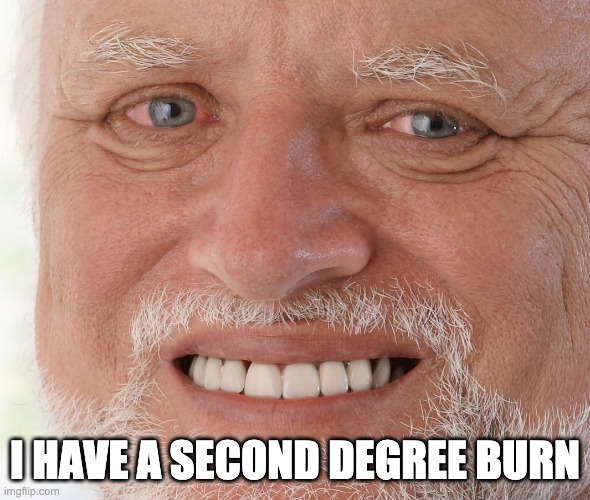 AHH IT HURTS | I HAVE A SECOND DEGREE BURN | image tagged in hide the pain harold | made w/ Imgflip meme maker