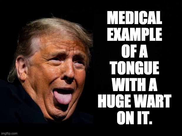 Why we don't put things in our mouths if we don't know where they've been. | MEDICAL
EXAMPLE
OF A
TONGUE
WITH A
HUGE WART
ON IT. | image tagged in memes,trump,huge wart,listen to me now | made w/ Imgflip meme maker