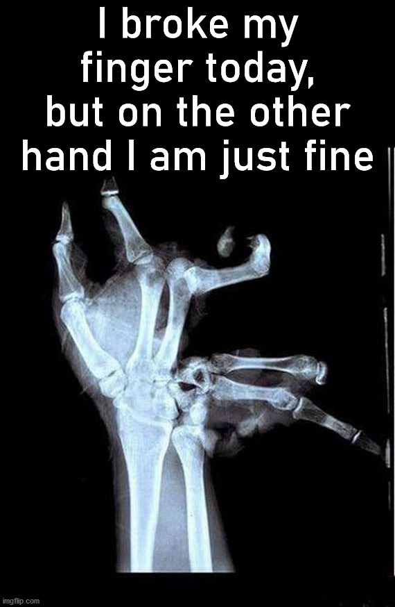 Broken Hand | I broke my finger today, but on the other hand I am just fine | image tagged in broken hand,eyeroll | made w/ Imgflip meme maker