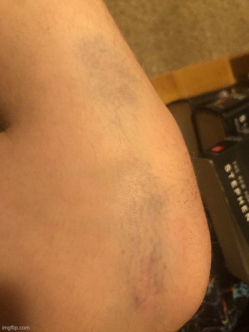 Broken Blood Vessel In My Knee - Day 2 | made w/ Imgflip meme maker