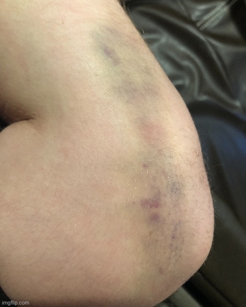 Broken Blood Vessel In My Knee - Day 3 | made w/ Imgflip meme maker