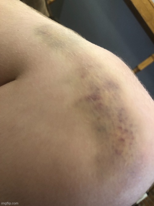 Broken Blood Vessel In My Knee - Day 4 | made w/ Imgflip meme maker