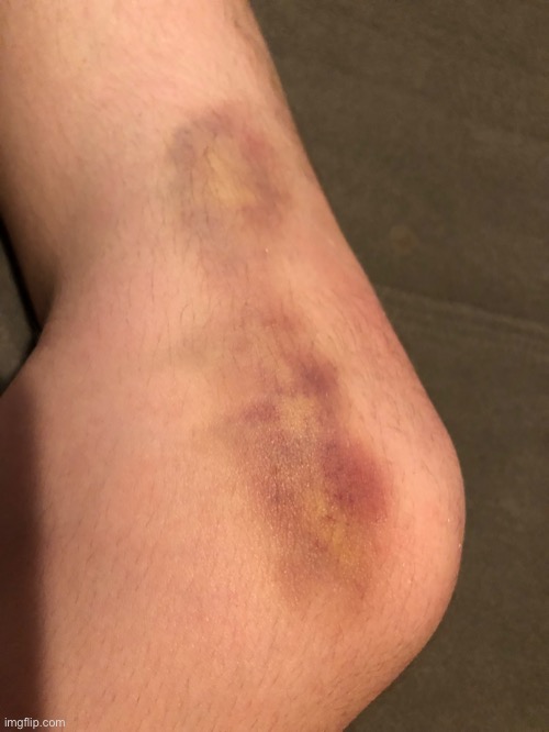Broken Blood Vessel In My Knee - Day 5 | made w/ Imgflip meme maker