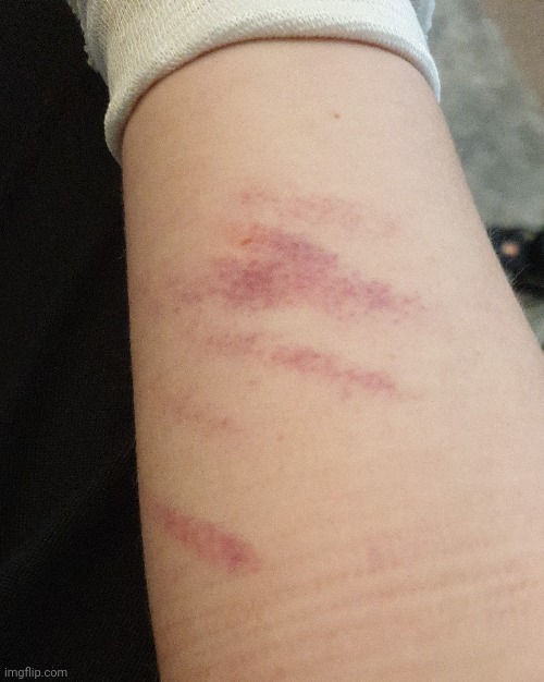 Hurt myself in rugby today also arm reveal ig | made w/ Imgflip meme maker