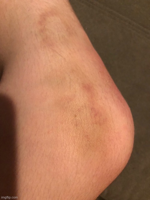 Broken Blood Vessel In My Knee - Day 7 | made w/ Imgflip meme maker