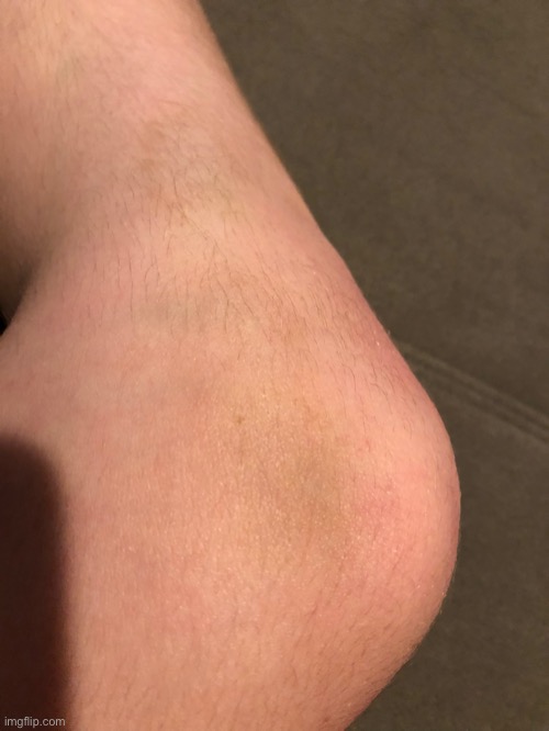 Broken Blood Vessel In My Knee - Day 8 | made w/ Imgflip meme maker