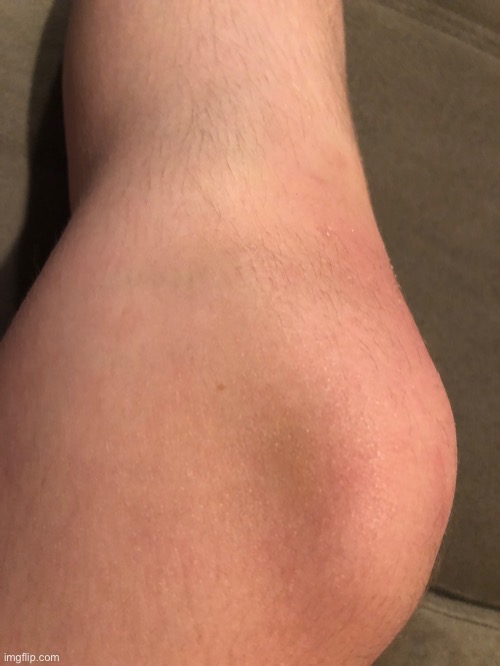 Broken Blood Vessel In My Knee - Day 8 - Last Update | made w/ Imgflip meme maker