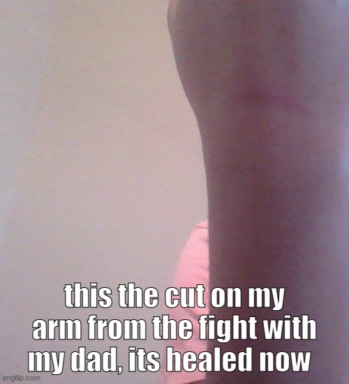 more of a bruise but- it got cut kinda | this the cut on my arm from the fight with my dad, its healed now | made w/ Imgflip meme maker