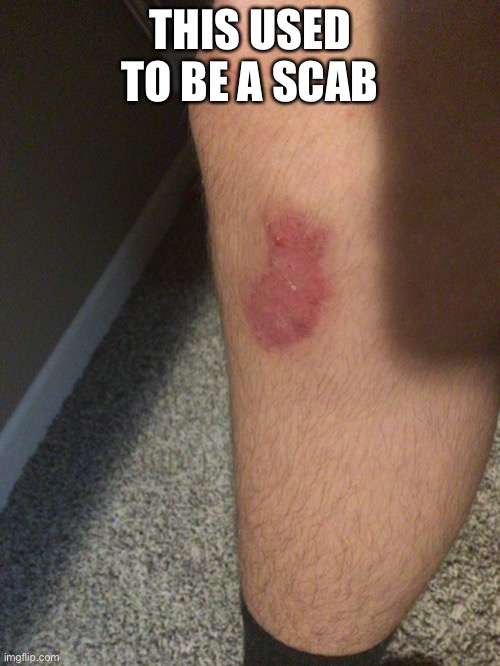 yes that is my leg | THIS USED TO BE A SCAB | made w/ Imgflip meme maker