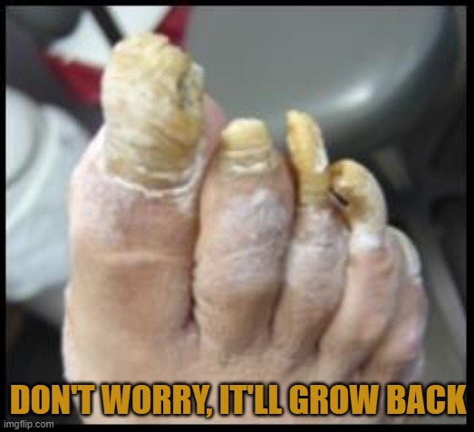 Ugly Toe Nails | DON'T WORRY, IT'LL GROW BACK | image tagged in ugly toe nails | made w/ Imgflip meme maker