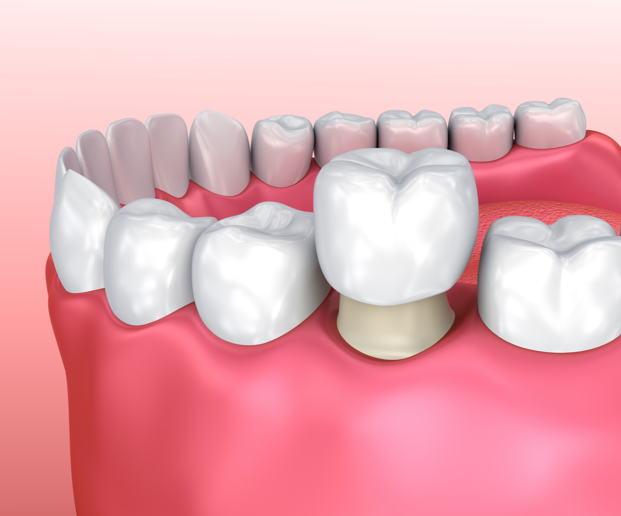 tooth crown dentist Blank Meme Template