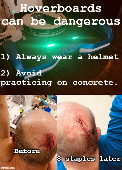 Hoverboards can be dangerous - wear a helmet | Hoverboards can be dangerous; 1) Always wear a helmet; 2) Avoid practicing on concrete. Before                              8 staples later | image tagged in hoverboard,accident,injury,stitches,concrete,christmas | made w/ Imgflip meme maker