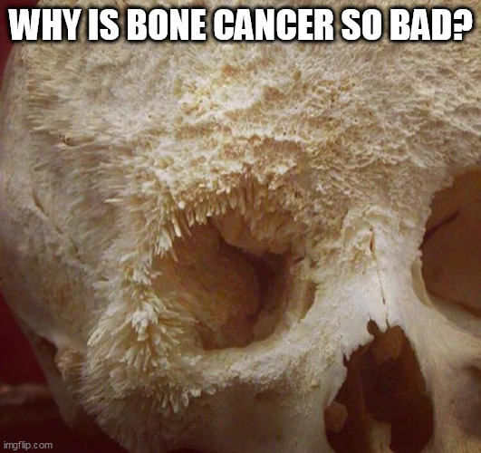 Bone cancer | WHY IS BONE CANCER SO BAD? | image tagged in bone cancer | made w/ Imgflip meme maker