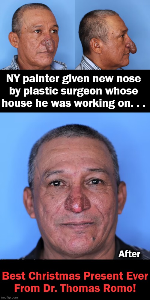 Feel Good Story of the Day.... | NY painter given new nose 
by plastic surgeon whose 
house he was working on. . . After; Best Christmas Present Ever

From Dr. Thomas Romo! | image tagged in fun,christmas gifts,surgeon,plastic surgery,happy,best | made w/ Imgflip meme maker