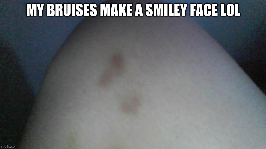 haha | MY BRUISES MAKE A SMILEY FACE LOL | image tagged in haha | made w/ Imgflip meme maker