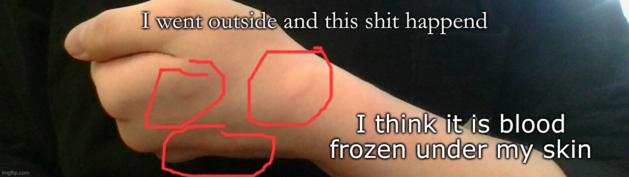 I went outside and this shit happend; I think it is blood frozen under my skin | made w/ Imgflip meme maker
