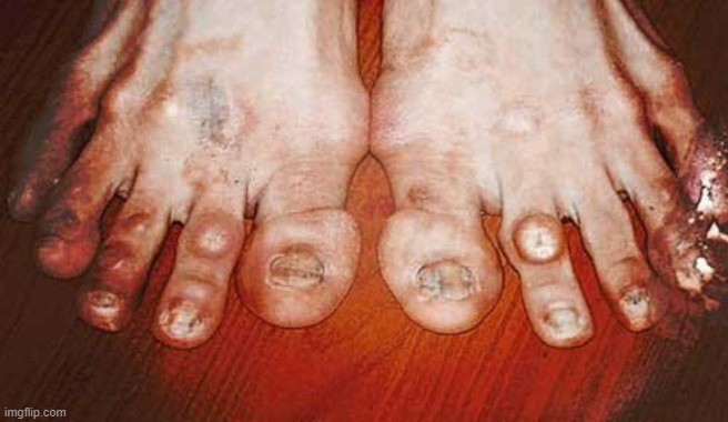 Ugly Feet | image tagged in ugly feet | made w/ Imgflip meme maker