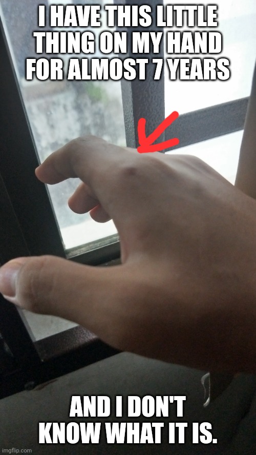 anyways how are y'all (also dunno if i should see a doctor) (Blaziken note cuz I'm banned: see a doctor, it ain't normal...) | I HAVE THIS LITTLE THING ON MY HAND FOR ALMOST 7 YEARS; AND I DON'T KNOW WHAT IT IS. | made w/ Imgflip meme maker