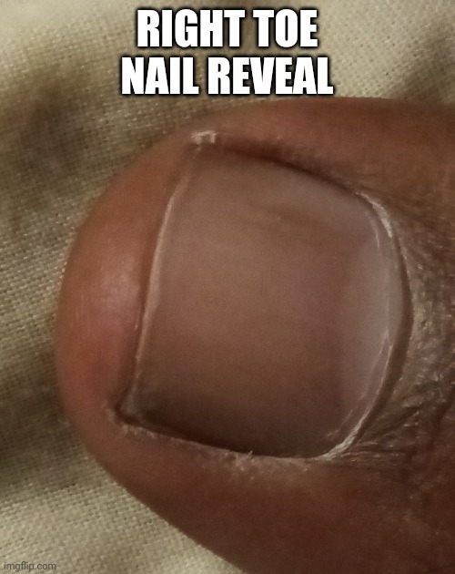 Can anyone see, I have fungus infection | RIGHT TOE NAIL REVEAL | image tagged in unfunny,reveal | made w/ Imgflip meme maker