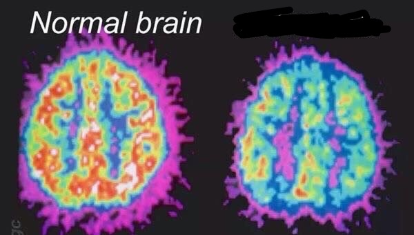 High Quality Normal brain vs mentally ill brain Blank Meme Template