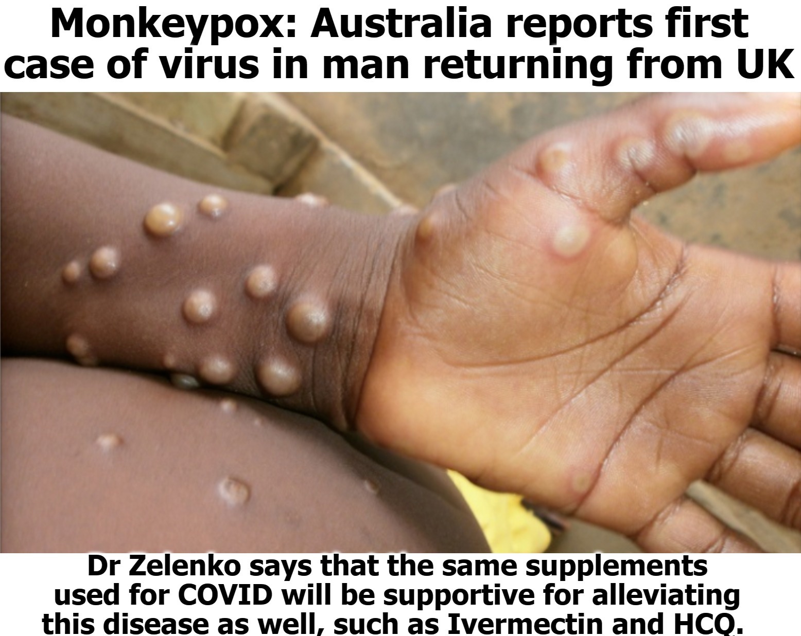 Now THIS is Monkeypox! Looks absolutely nothing like Shingles. | image tagged in revelation,apocalypse,seven angels of the apocalypse,seven bowls,grapes of wrath,repent | made w/ Imgflip meme maker