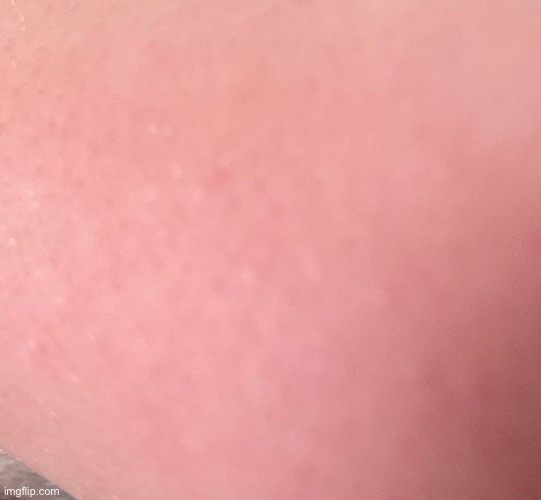 I hate sunburns (this is my arm) | made w/ Imgflip meme maker