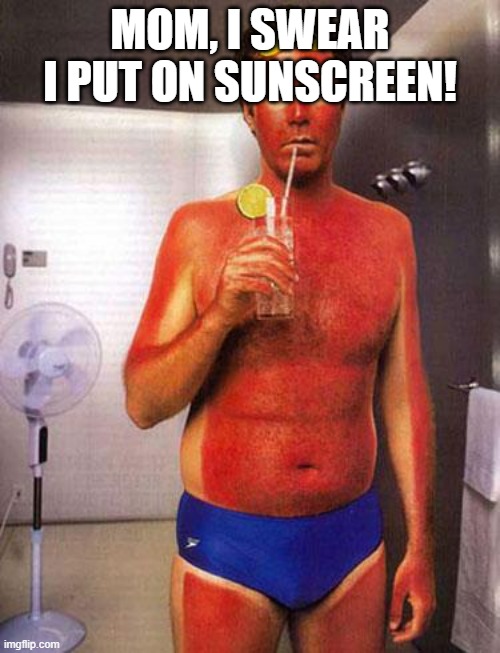funny sunburn pictures