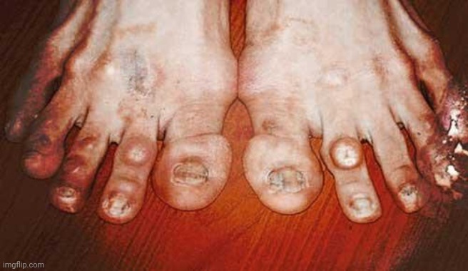 toe fungus amoung us | image tagged in ugly feet | made w/ Imgflip meme maker
