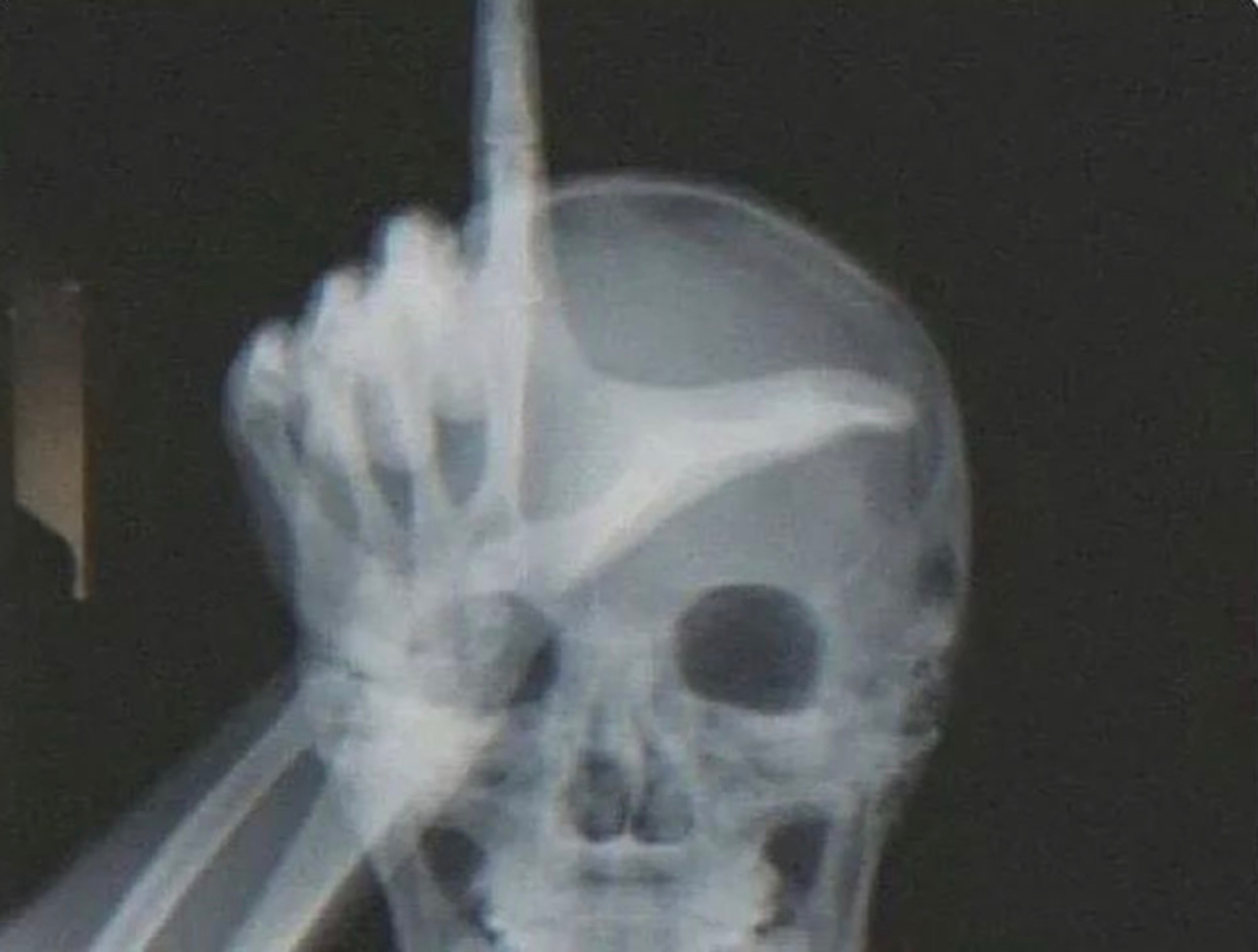 Take the L on a X-Ray Blank Meme Template