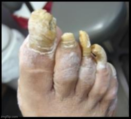 Ugly Toe Nails | image tagged in ugly toe nails | made w/ Imgflip meme maker