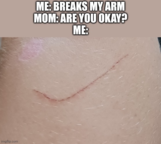 This was an actual bruise on my brother's arm |  ME: BREAKS MY ARM
MOM: ARE YOU OKAY?
ME: | image tagged in hurt,break,mom,parents | made w/ Imgflip meme maker