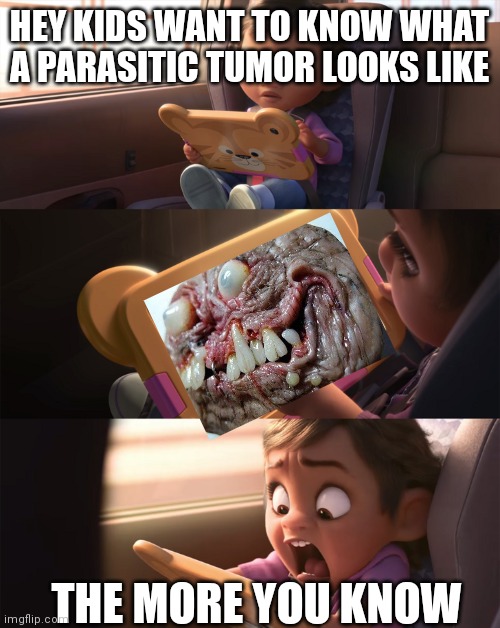 Real Life Parasyte | HEY KIDS WANT TO KNOW WHAT A PARASITIC TUMOR LOOKS LIKE; THE MORE YOU KNOW | image tagged in wreck it ralph 2 | made w/ Imgflip meme maker