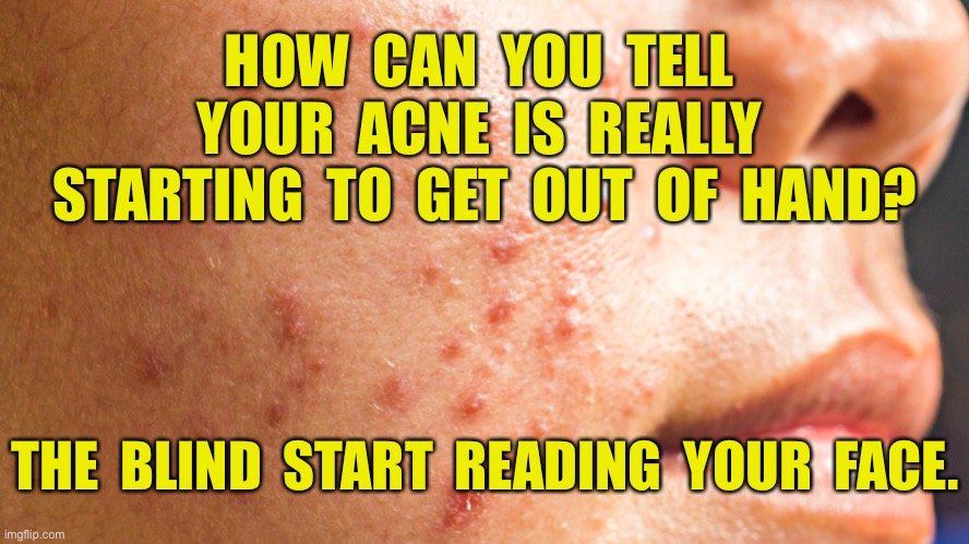 Acne | HOW  CAN  YOU  TELL  YOUR  ACNE  IS  REALLY  STARTING  TO  GET  OUT  OF  HAND? THE  BLIND  START  READING  YOUR  FACE. | image tagged in acne,out of control,spots,blind can,read your face,dark humour | made w/ Imgflip meme maker