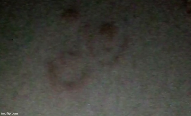 My burn marks look like a smiley face | made w/ Imgflip meme maker