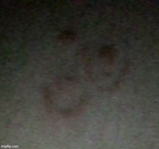 My burn marks looks like a smiley face :) | made w/ Imgflip meme maker