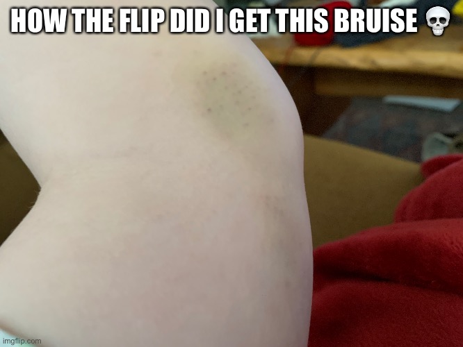 E | HOW THE FLIP DID I GET THIS BRUISE 💀 | made w/ Imgflip meme maker