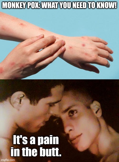 Monkey Pox - starts with a Jab in the rear, Ends with a Jab in the arm. | MONKEY POX: WHAT YOU NEED TO KNOW! It's a pain in the butt. | image tagged in gay men,monkey,monkeypox | made w/ Imgflip meme maker