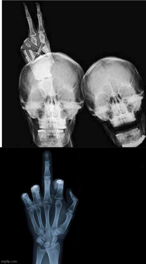 image tagged in bones,xray finger | made w/ Imgflip meme maker