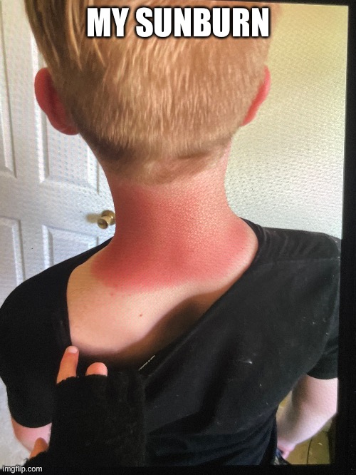 Whiteboy summer | MY SUNBURN | made w/ Imgflip meme maker