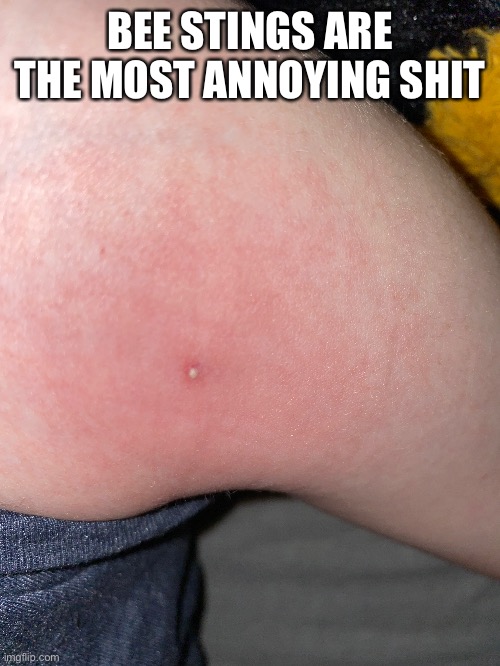 BEE STINGS ARE THE MOST ANNOYING SHIT | made w/ Imgflip meme maker