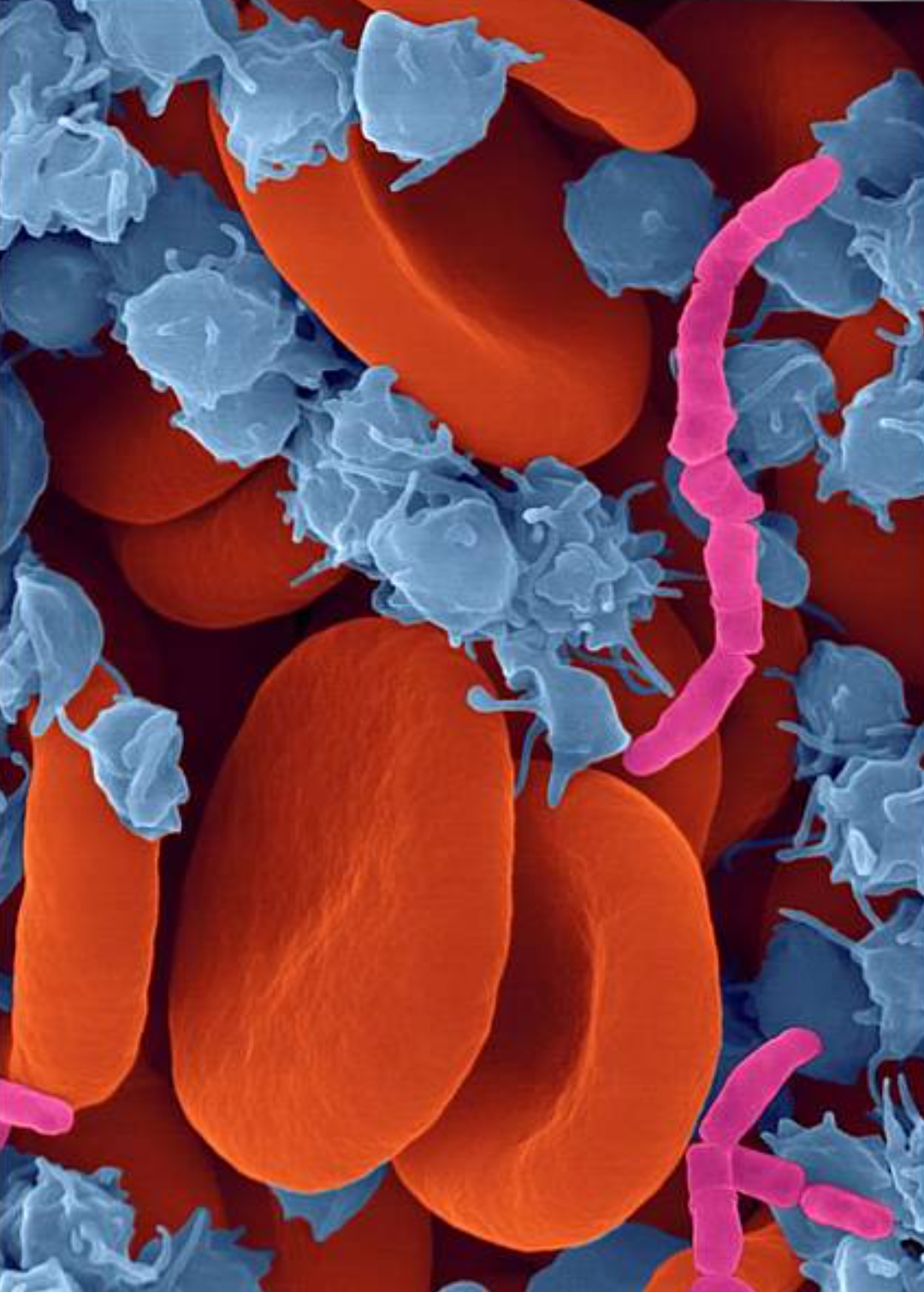 High Quality Sepsis Blank Meme Template