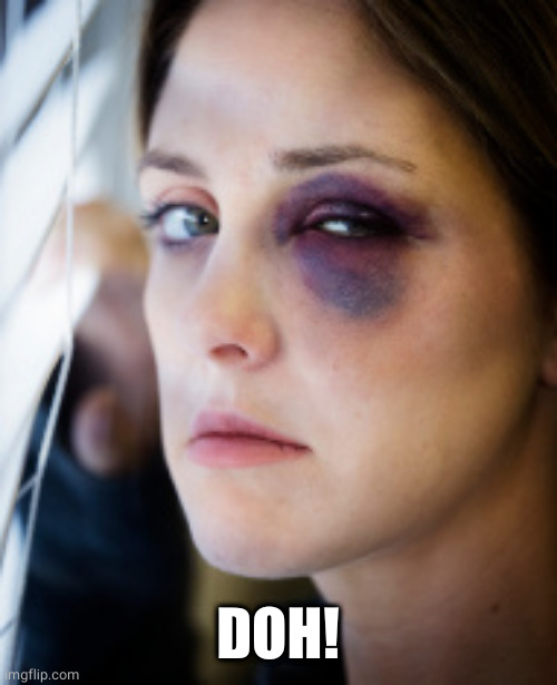 black eye | DOH! | image tagged in black eye | made w/ Imgflip meme maker