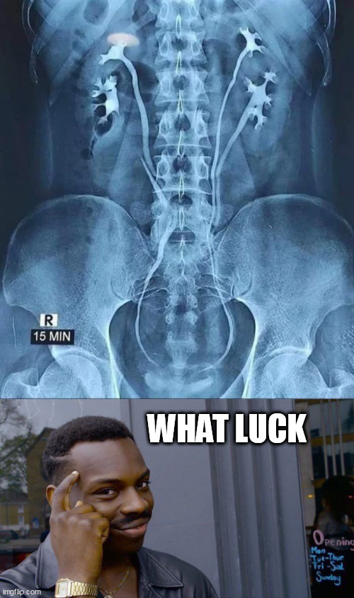 WHAT LUCK | image tagged in 4 kidneys,memes,roll safe think about it | made w/ Imgflip meme maker