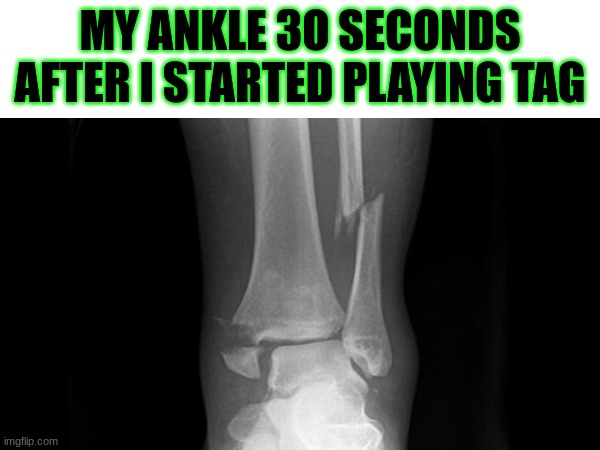 pray 4 me | MY ANKLE 3O SECONDS AFTER I STARTED PLAYING TAG | image tagged in relatable | made w/ Imgflip meme maker